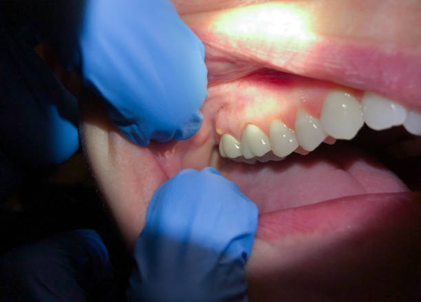 Best Emergency Dentist for Lost Fillings or Crowns in Westernport, MD